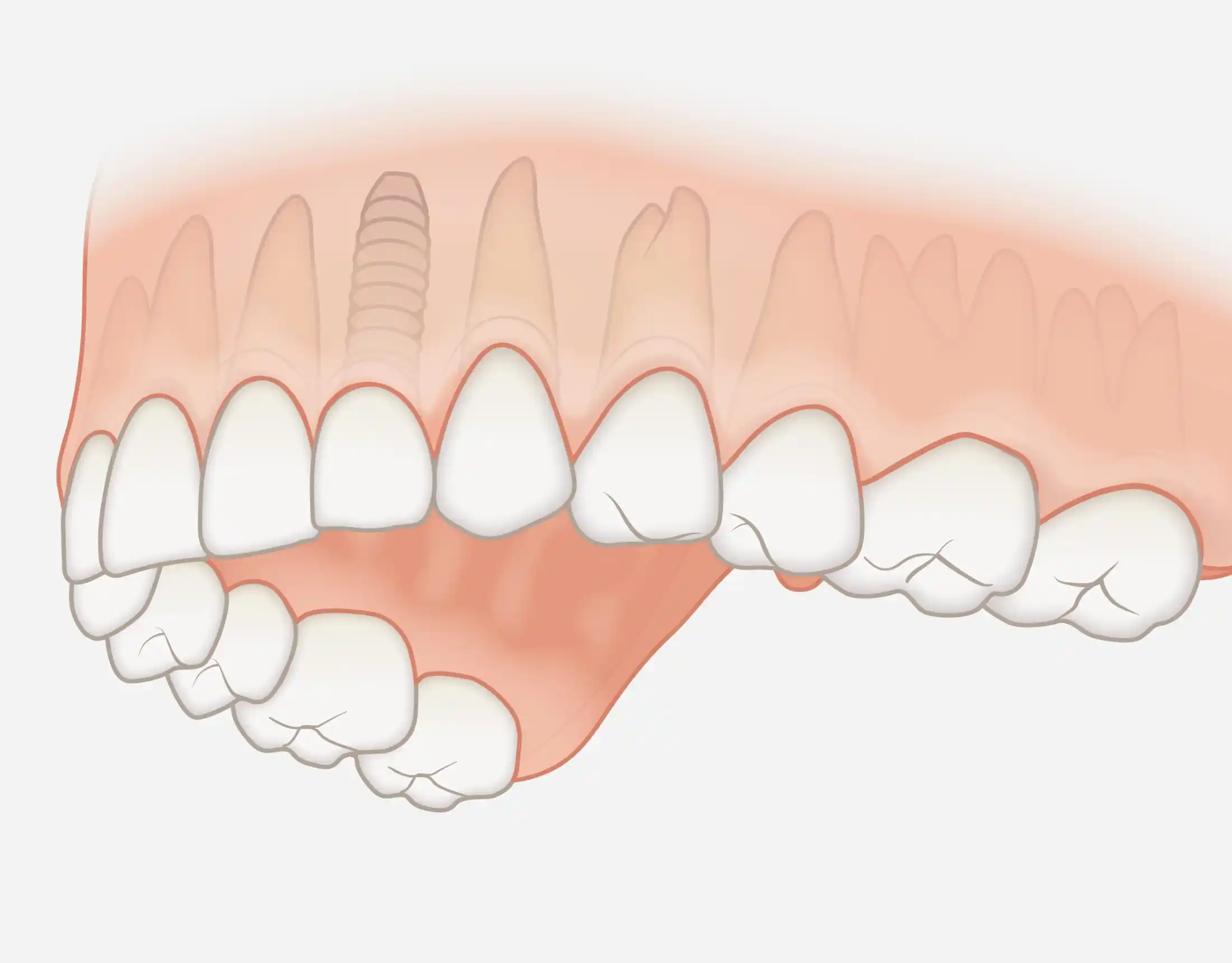 Remplacement d’une dent isolée