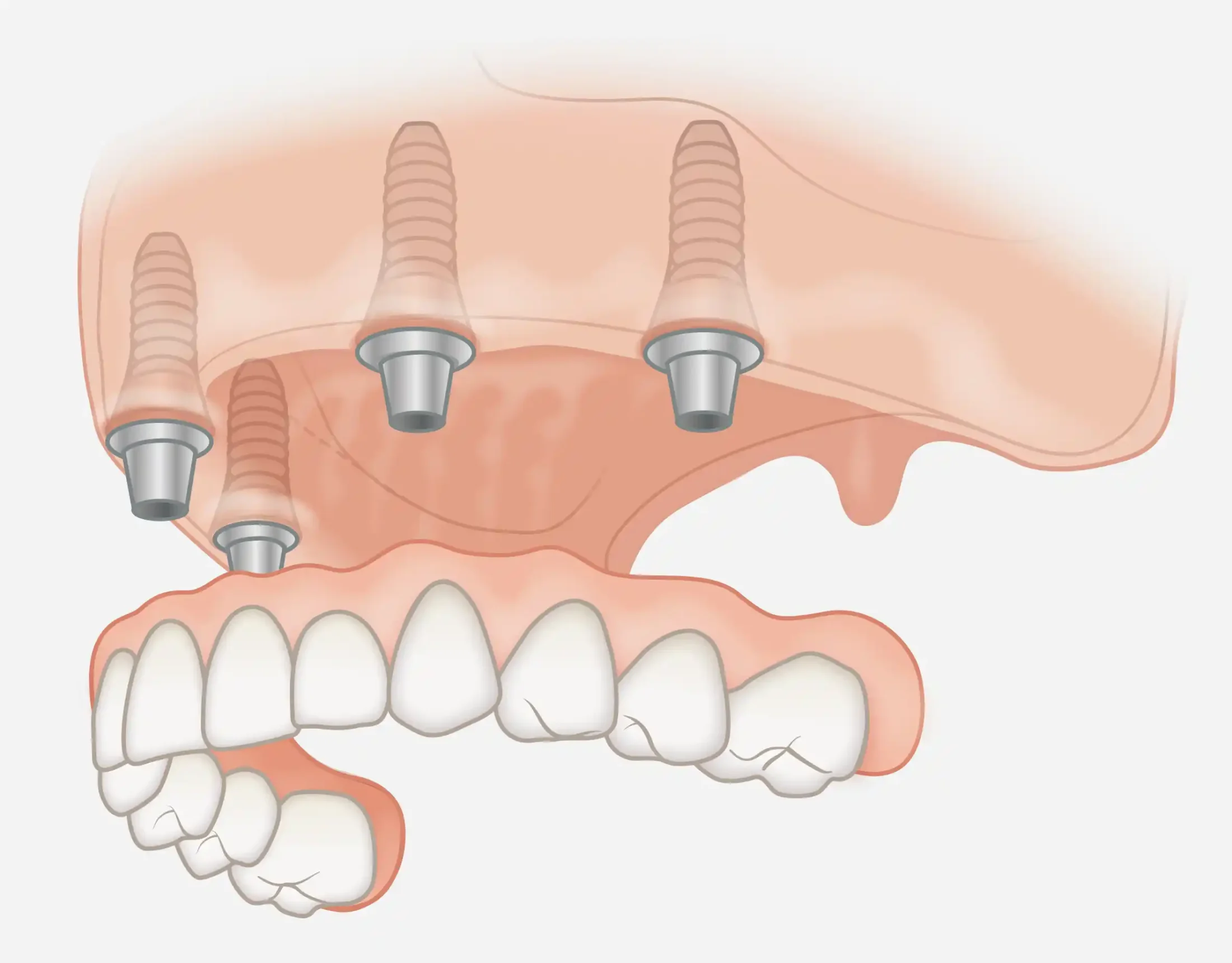 Prothèse amovible sur implant