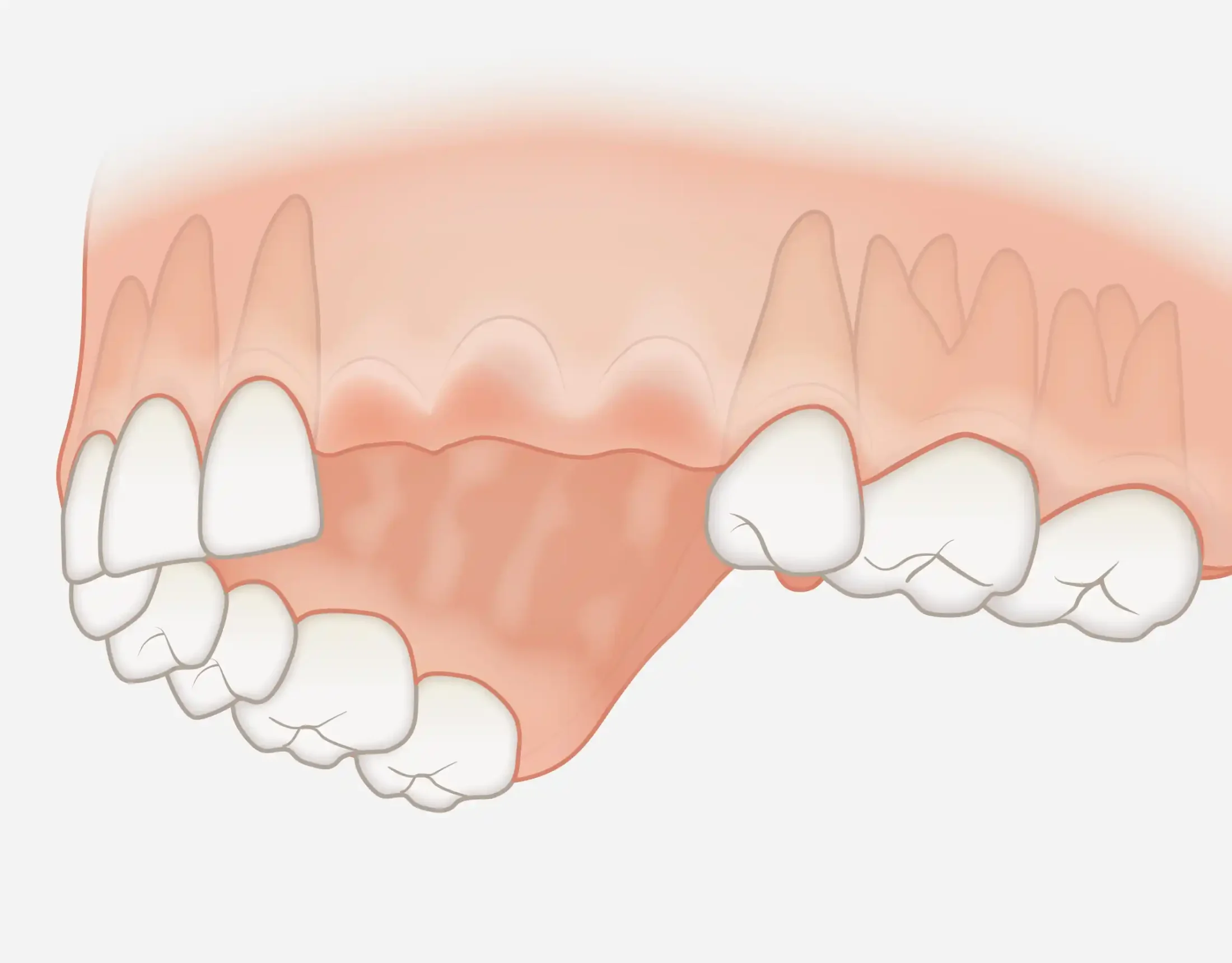 Remplacement d’un groupe de dents