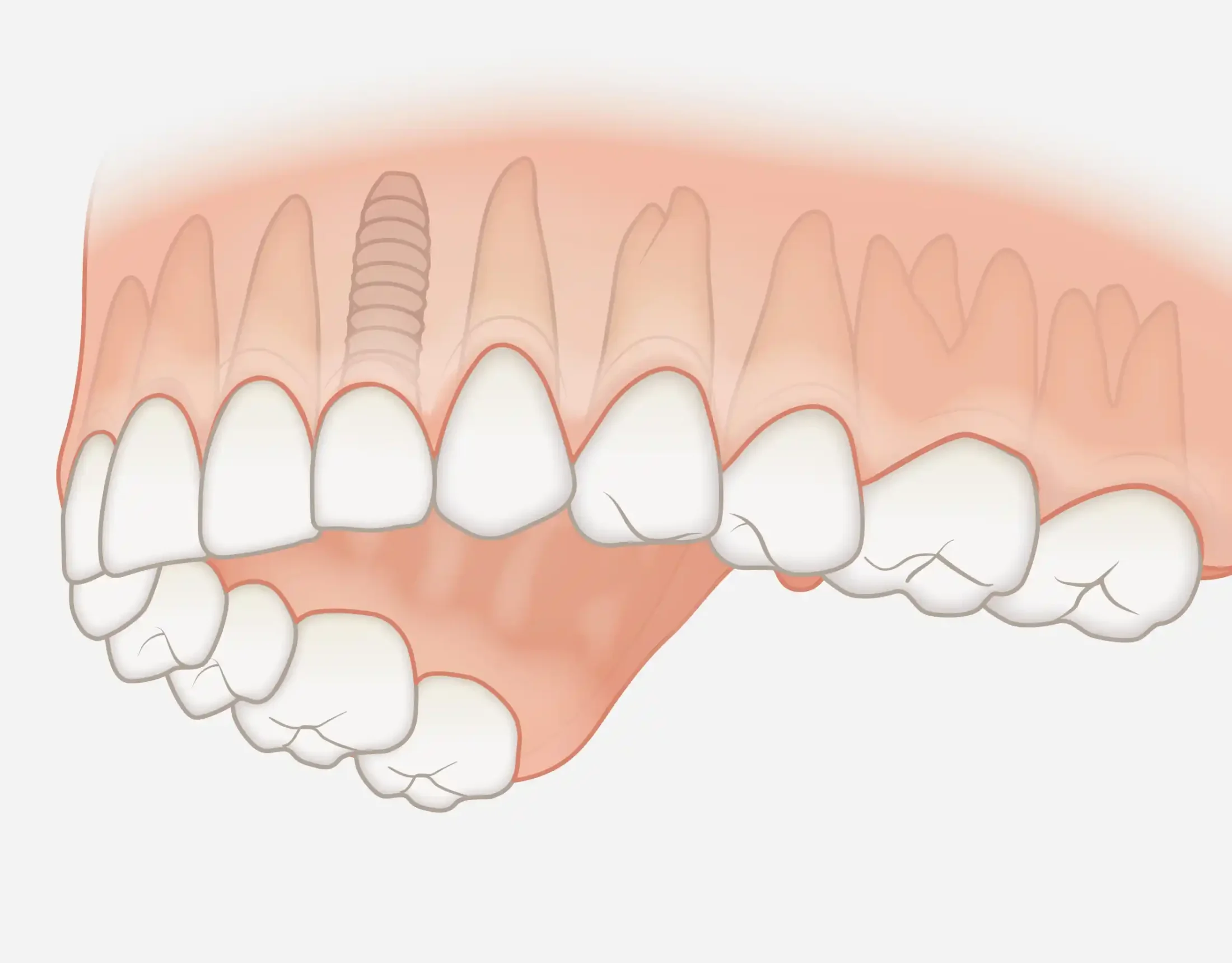 Einzelzahnersatz Implantat